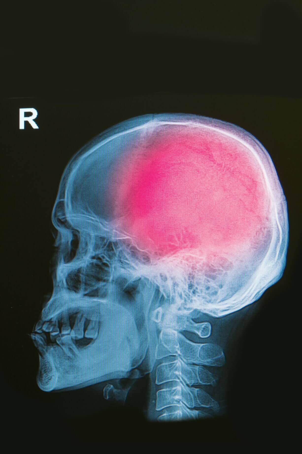 Traumatic Brain Injury: Signs, Symptoms, and What to Do